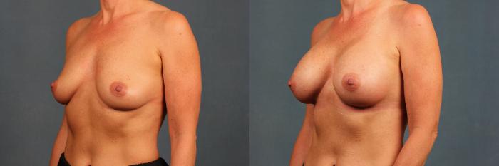 Before & After Enlargement - Silicone Case 488 View #4 View in Louisville & Lexington, KY