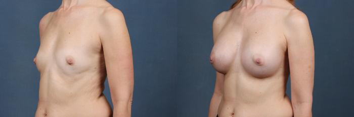 Before & After Enlargement - Silicone Case 489 View #2 View in Louisville & Lexington, KY