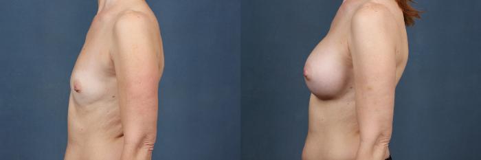 Before & After Enlargement - Silicone Case 489 View #3 View in Louisville & Lexington, KY