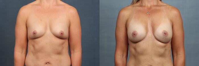 Before & After Enlargement - Silicone Case 589 View #1 View in Louisville & Lexington, KY