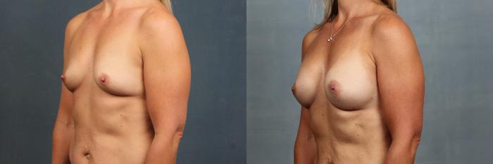 Before & After Enlargement - Silicone Case 589 View #2 View in Louisville & Lexington, KY