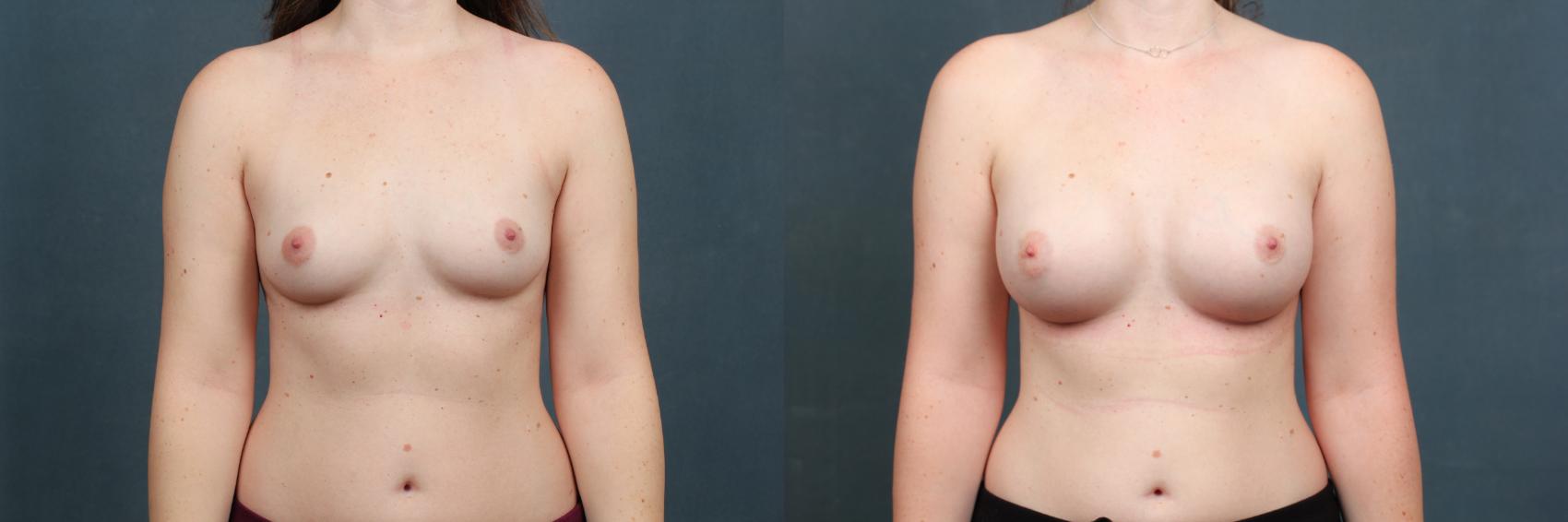 Before & After Enlargement - Silicone Case 600 View #1 View in Louisville & Lexington, KY