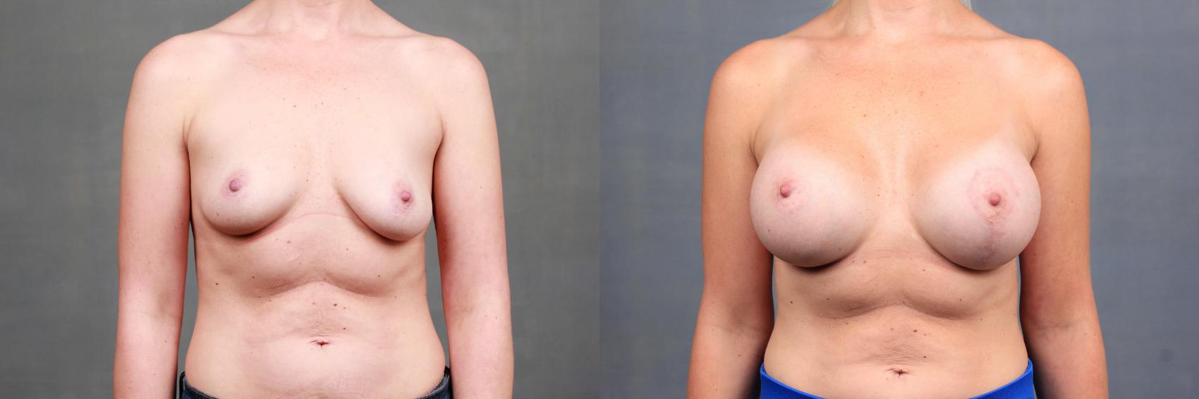 Before & After Enlargement - Silicone Case 759 Front View in Louisville & Lexington, KY