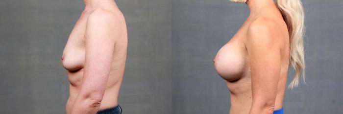Before & After Enlargement - Silicone Case 759 Left Side View in Louisville & Lexington, KY