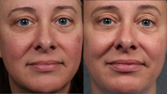 Before & After Excel V Laser Treatment Case 685 Front View in Louisville & Lexington, KY