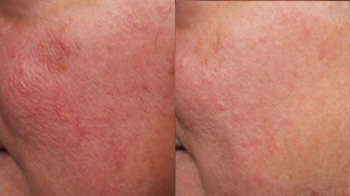 Before & After Excel V Laser Treatment Case 685 Left Side View in Louisville & Lexington, KY