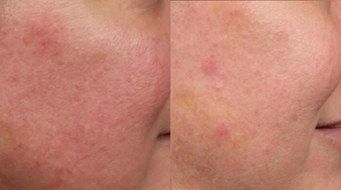 Before & After Excel V Laser Treatment Case 685 Right Side View in Louisville & Lexington, KY