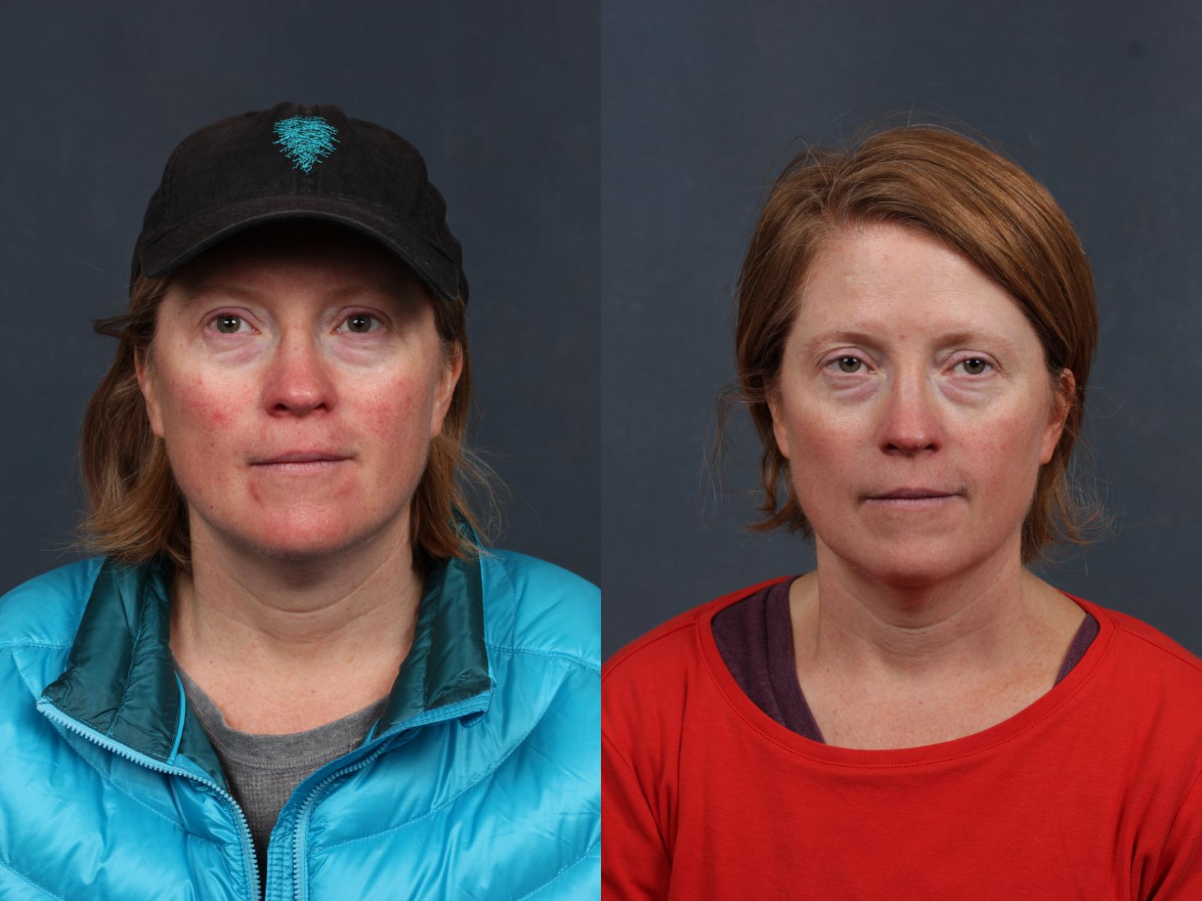 excel-v-laser-treatment-before-after-photos-patient-693-louisville