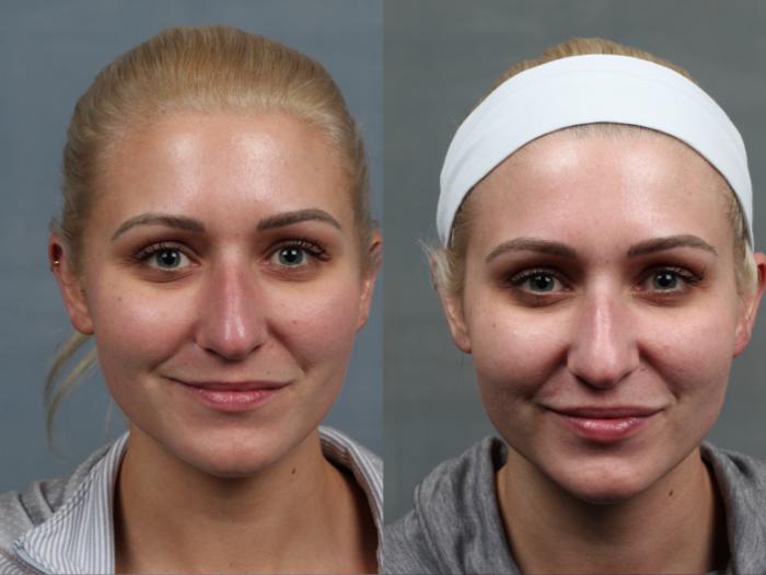 Before & After Excel V Laser Treatment Case 694 Front View in Louisville & Lexington, KY