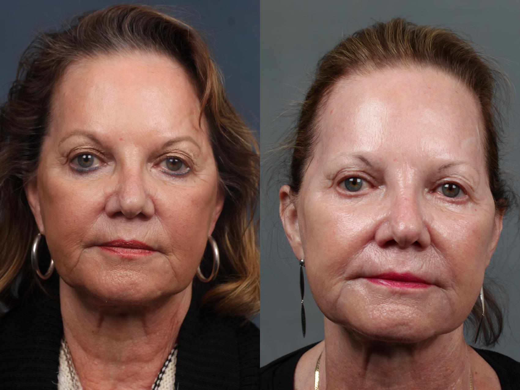 Before & After Excel V Laser Treatment Case 697 Front View in Louisville, KY