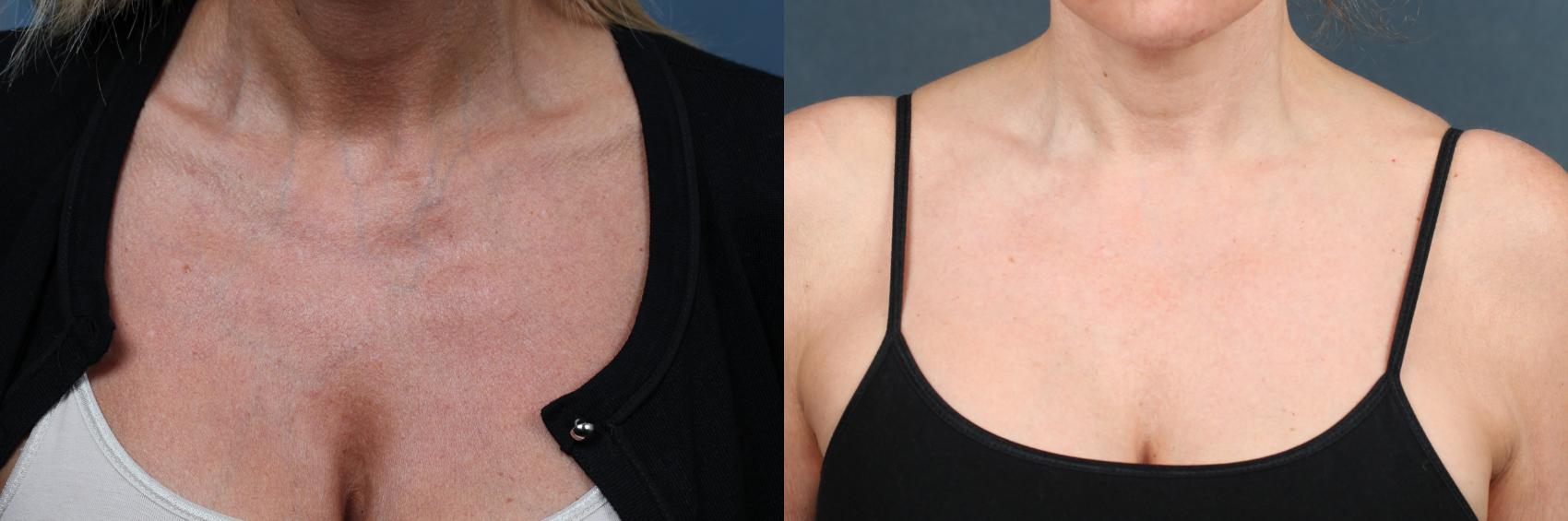 Before & After Excel V Laser Treatment Case 699 Front View in Louisville, KY