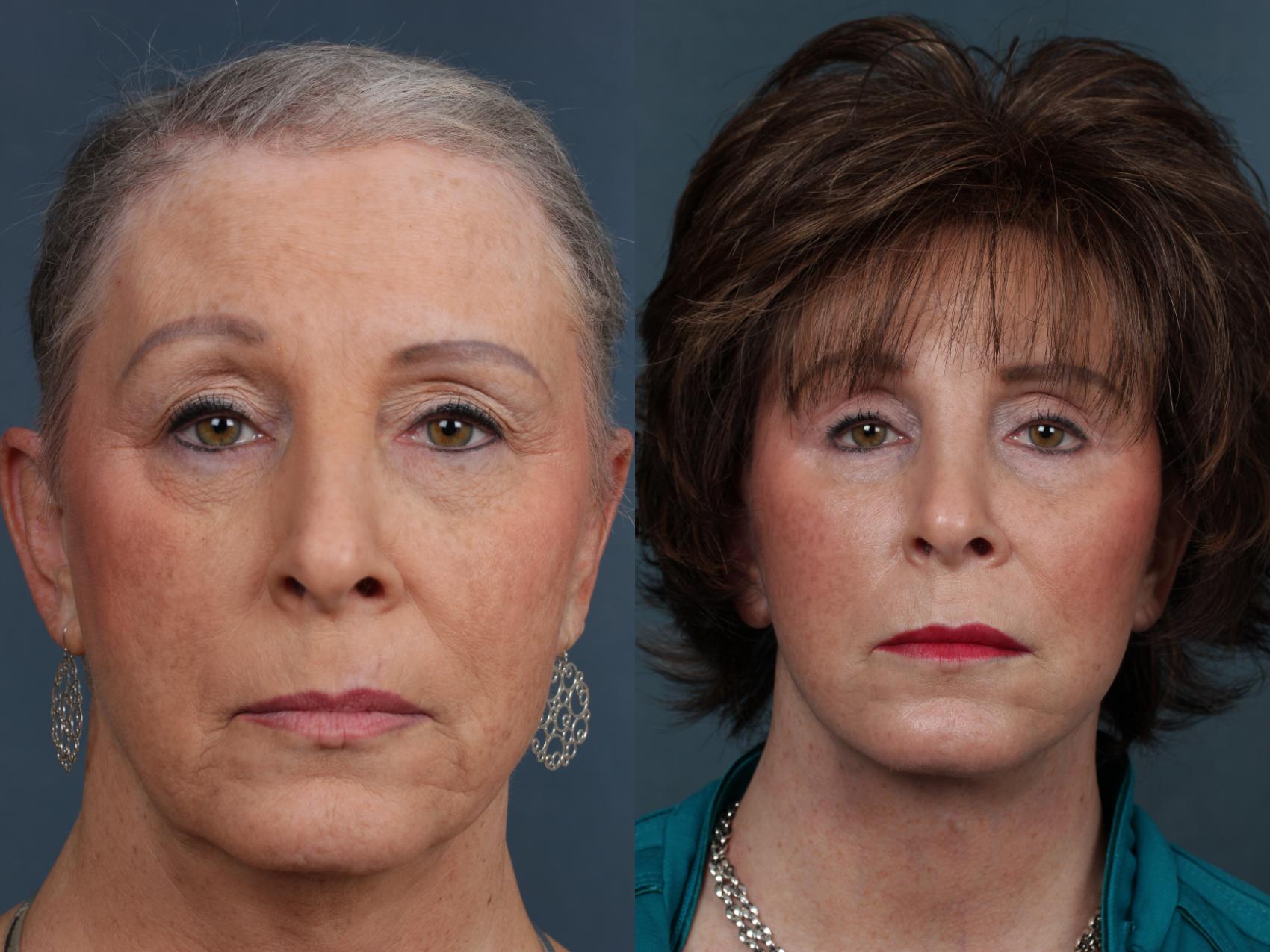 Before & After Eyelid Surgery Case 512 View #1 View in Louisville & Lexington, KY