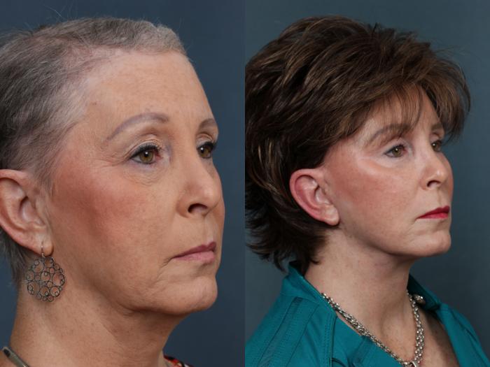 Eyelid Surgery Case 512 Before & After View #2 | Louisville, KY | CaloSpa® Rejuvenation Center