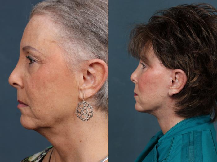 Eyelid Surgery Case 512 Before & After View #3 | Louisville, KY | CaloSpa® Rejuvenation Center
