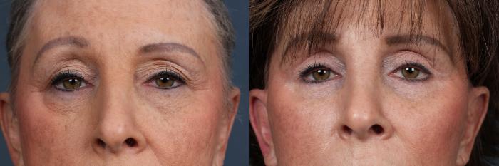 Eyelid Surgery Case 512 Before & After View #4 | Louisville, KY | CaloSpa® Rejuvenation Center