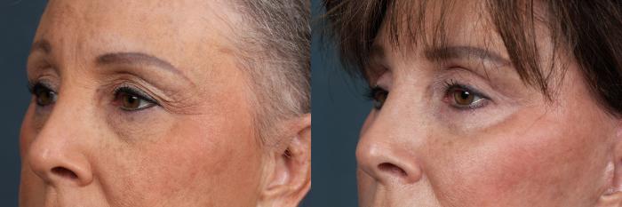 Eyelid Surgery Case 512 Before & After View #5 | Louisville, KY | CaloSpa® Rejuvenation Center