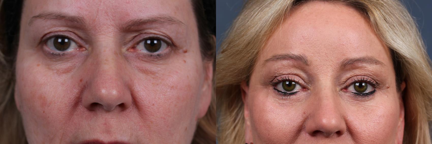 Before & After Eyelid Surgery Case 573 View #1 View in Louisville & Lexington, KY