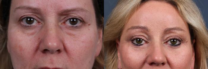 Eyelid Surgery Case 573 Before & After View #1 | Louisville, KY | CaloSpa® Rejuvenation Center