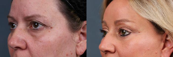 Eyelid Surgery Case 573 Before & After View #2 | Louisville, KY | CaloSpa® Rejuvenation Center
