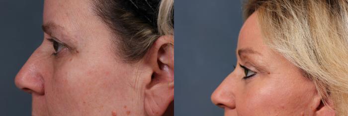 Eyelid Surgery Case 573 Before & After View #3 | Louisville, KY | CaloSpa® Rejuvenation Center