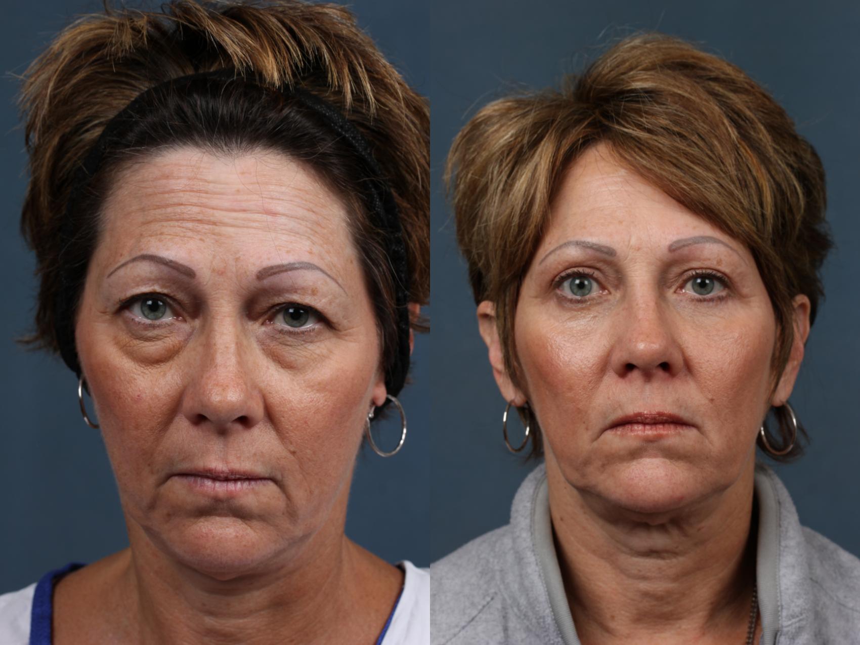 Before & After Eyelid Surgery Case 574 View #1 View in Louisville, KY