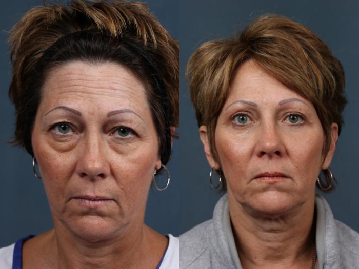 Before & After Eyelid Surgery Case 574 View #1 View in Louisville & Lexington, KY