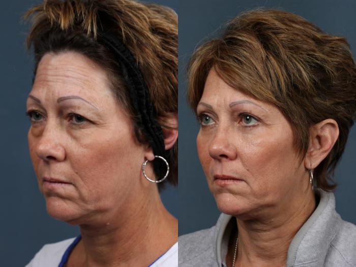 Eyelid Surgery Case 574 Before & After View #2 | Louisville, KY | CaloSpa® Rejuvenation Center