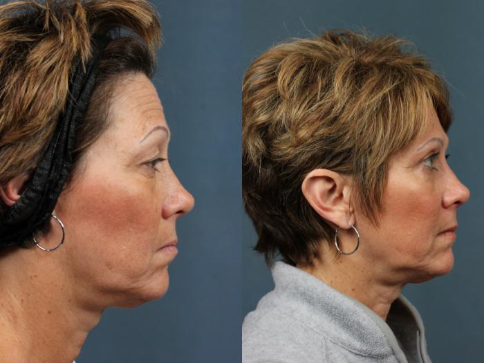 Eyelid Surgery Case 574 Before & After View #3 | Louisville, KY | CaloSpa® Rejuvenation Center