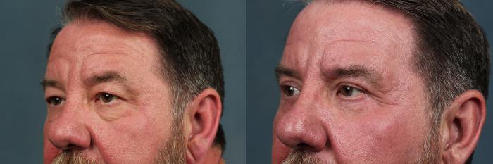 Eyelid Surgery Case 575 Before & After View #2 | Louisville, KY | CaloSpa® Rejuvenation Center