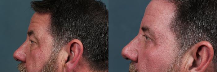 Eyelid Surgery Case 575 Before & After View #3 | Louisville, KY | CaloSpa® Rejuvenation Center