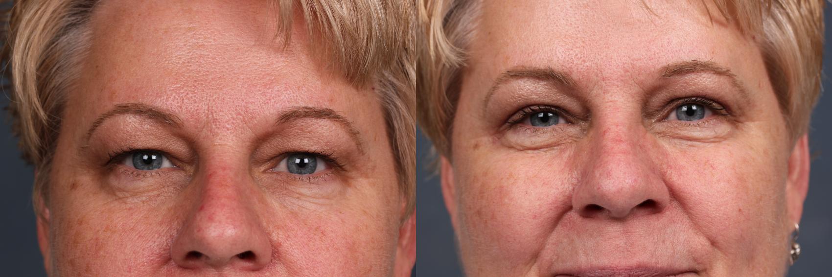 Before & After Eyelid Surgery Case 576 View #1 View in Louisville & Lexington, KY