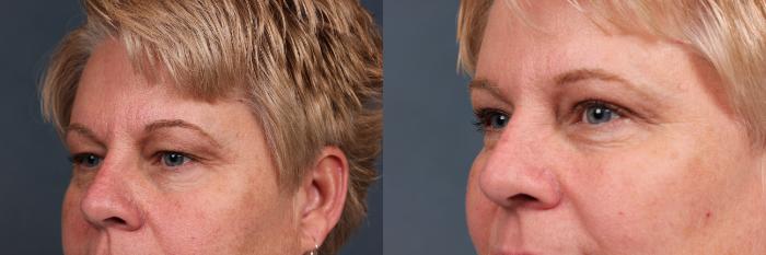Eyelid Surgery Case 576 Before & After View #2 | Louisville, KY | CaloSpa® Rejuvenation Center
