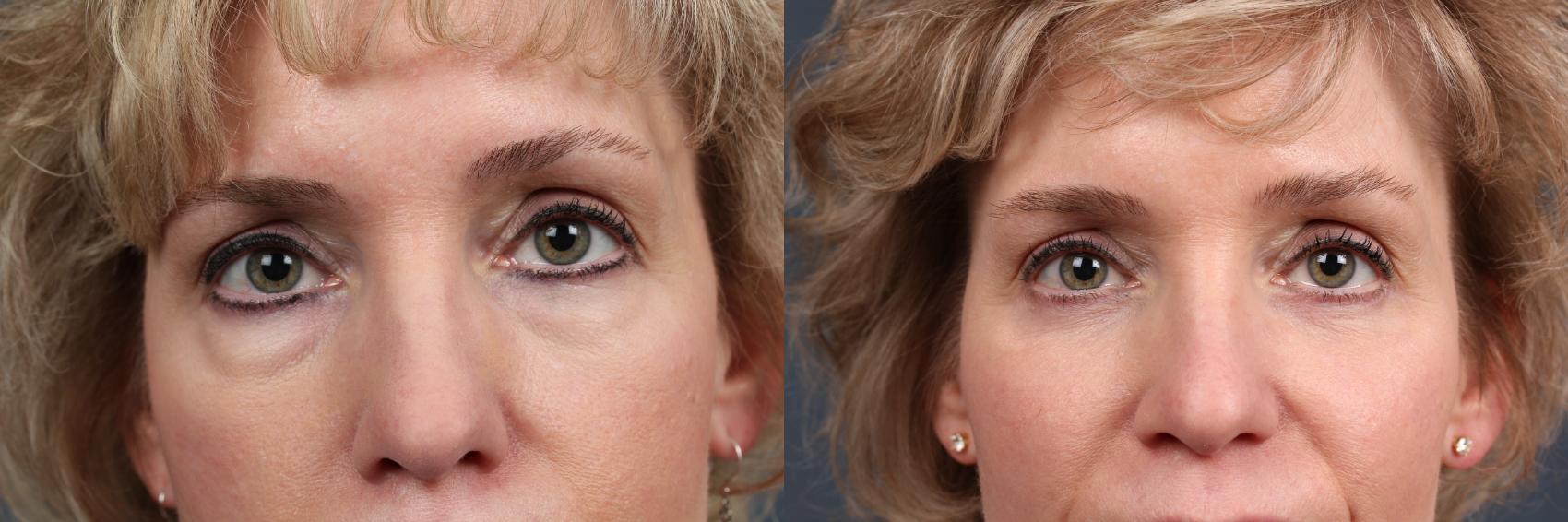 Before & After Eyelid Surgery Case 577 View #1 View in Louisville & Lexington, KY
