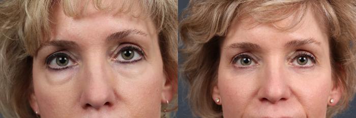 Eyelid Surgery Case 577 Before & After View #1 | Louisville, KY | CaloSpa® Rejuvenation Center