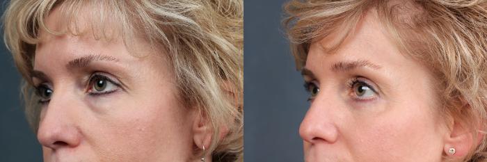 Eyelid Surgery Case 577 Before & After View #2 | Louisville, KY | CaloSpa® Rejuvenation Center