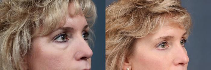 Before & After Eyelid Surgery Case 577 View #3 View in Louisville & Lexington, KY