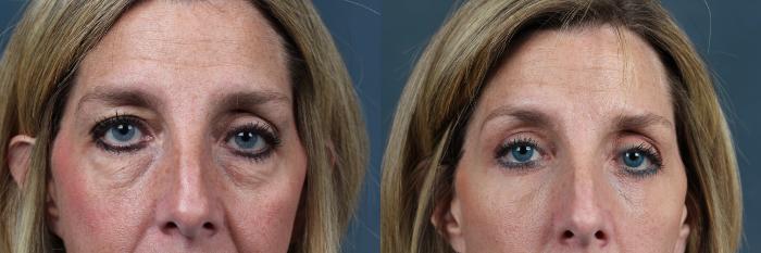 Before & After Eyelid Surgery Case 578 View #1 View in Louisville & Lexington, KY