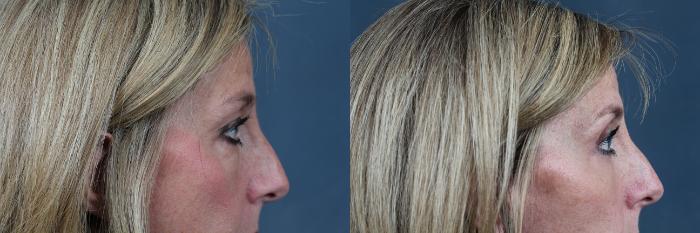 Eyelid Surgery Case 578 Before & After View #2 | Louisville, KY | CaloSpa® Rejuvenation Center