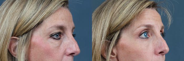 Eyelid Surgery Case 578 Before & After View #3 | Louisville, KY | CaloSpa® Rejuvenation Center