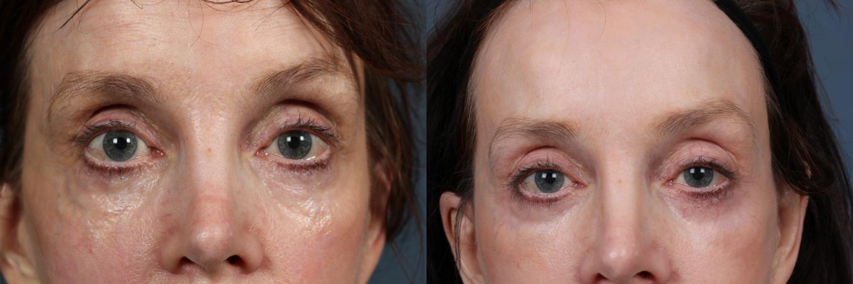 Before & After Eyelid Surgery Case 579 View #1 View in Louisville, KY