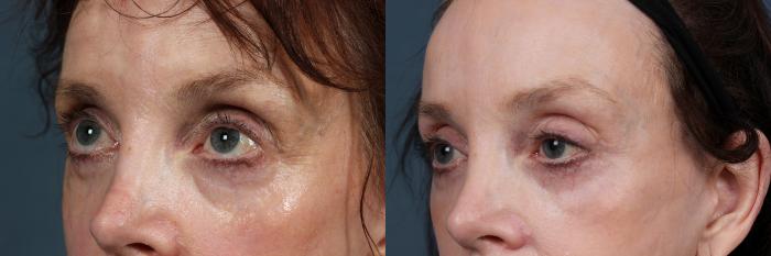 Eyelid Surgery Case 579 Before & After View #2 | Louisville, KY | CaloSpa® Rejuvenation Center