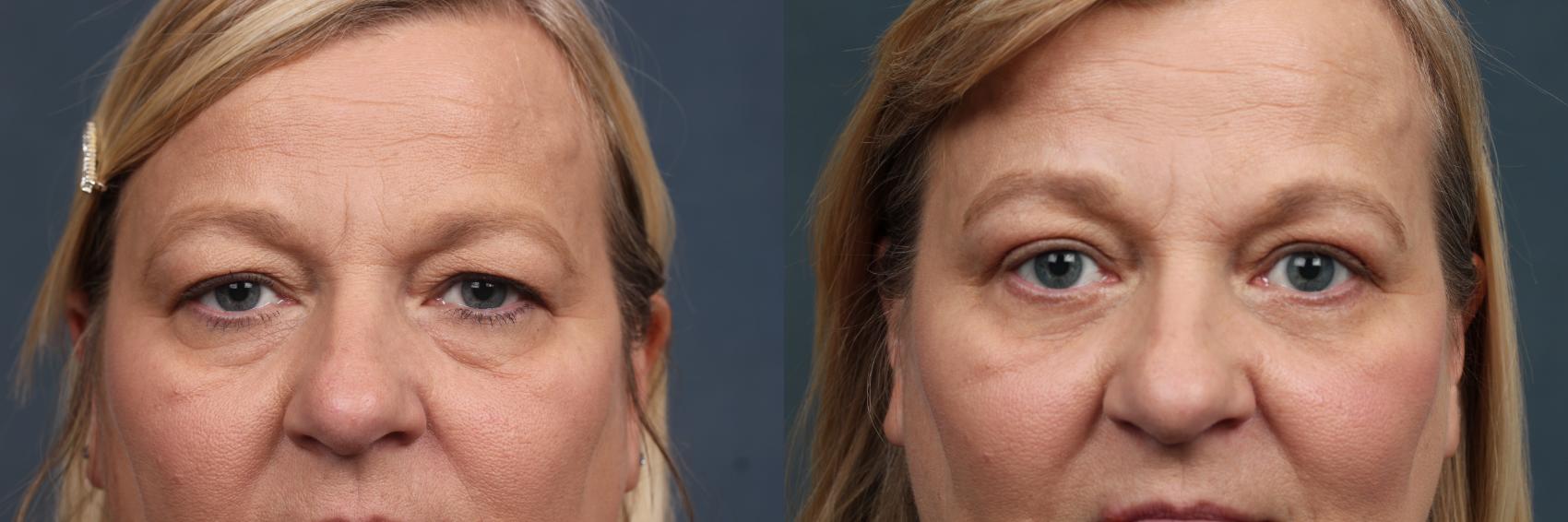 Before & After Eyelid Surgery Case 580 View #1 View in Louisville, KY