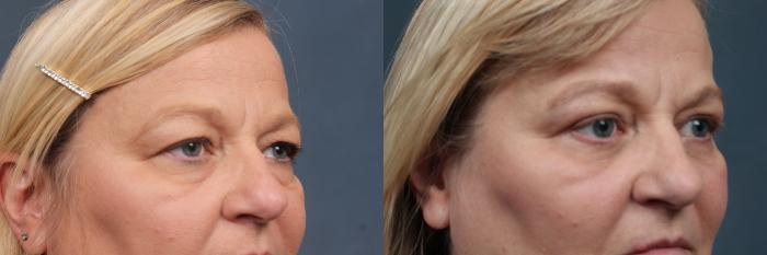 Eyelid Surgery Case 580 Before & After View #2 | Louisville, KY | CaloSpa® Rejuvenation Center