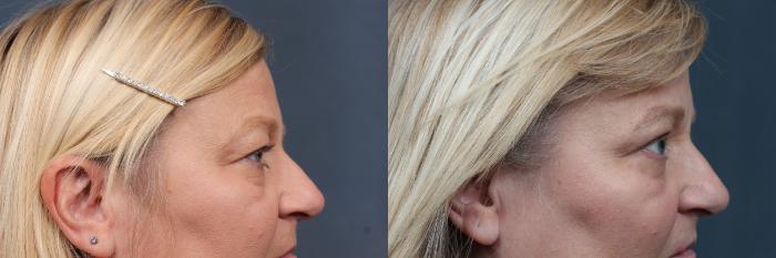 Eyelid Surgery Case 580 Before & After View #3 | Louisville, KY | CaloSpa® Rejuvenation Center