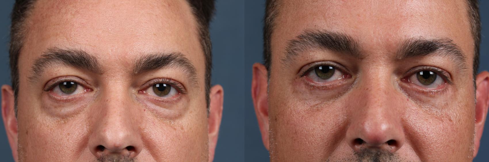 Before & After Eyelid Surgery Case 581 View #1 View in Louisville & Lexington, KY