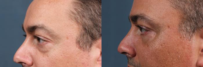 Eyelid Surgery Case 581 Before & After View #2 | Louisville, KY | CaloSpa® Rejuvenation Center
