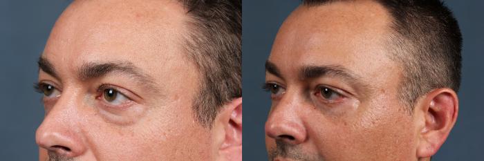 Eyelid Surgery Case 581 Before & After View #3 | Louisville, KY | CaloSpa® Rejuvenation Center