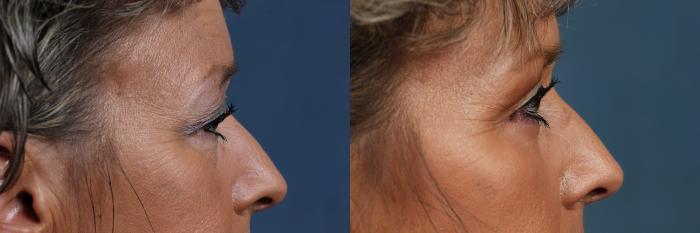 Eyelid Surgery Case 582 Before & After View #2 | Louisville, KY | CaloSpa® Rejuvenation Center