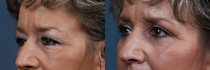 Before & After Eyelid Surgery Case 582 View #3 View in Louisville & Lexington, KY