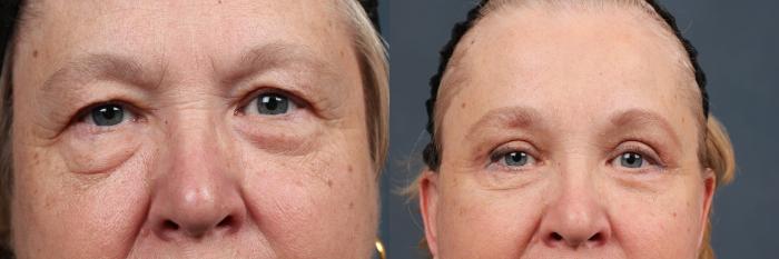 Before & After Eyelid Surgery Case 584 View #1 View in Louisville & Lexington, KY
